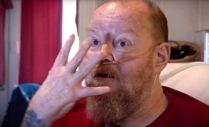 A patient described how misuse of oxygen burned him